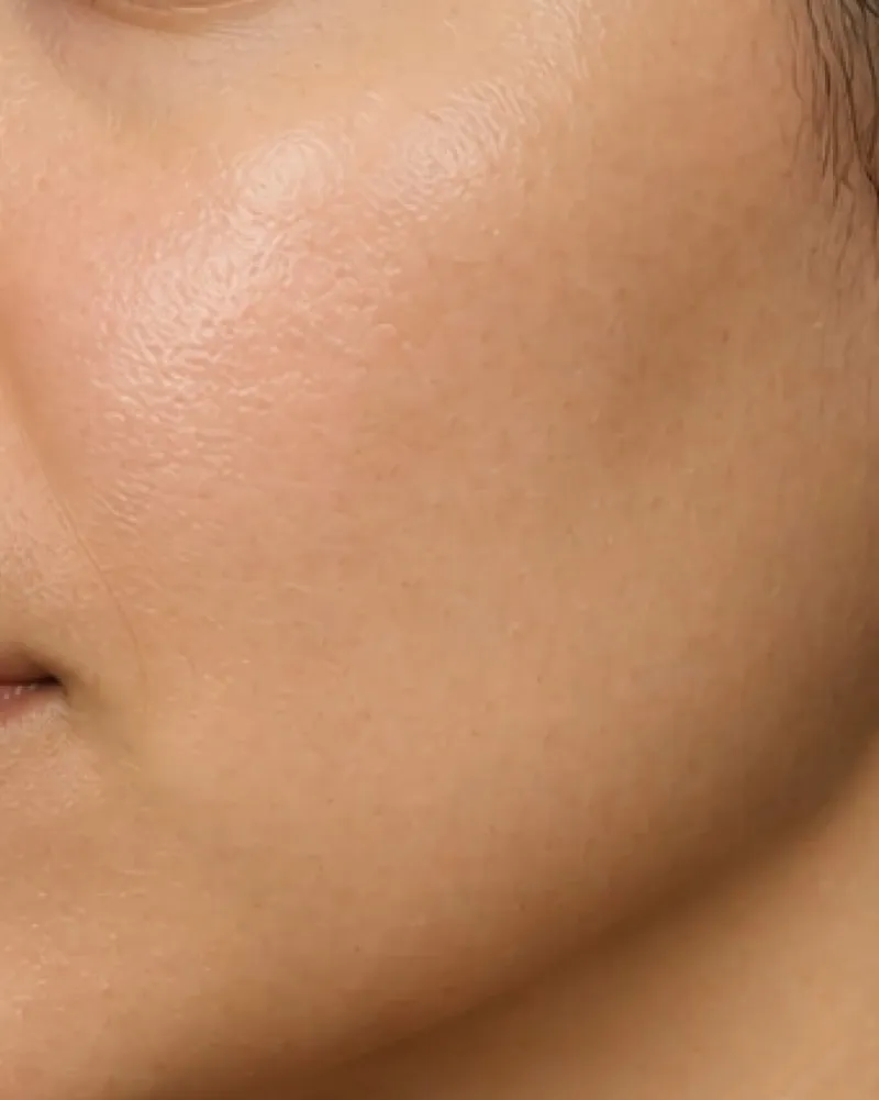 Laser Skin Rejuvenation after