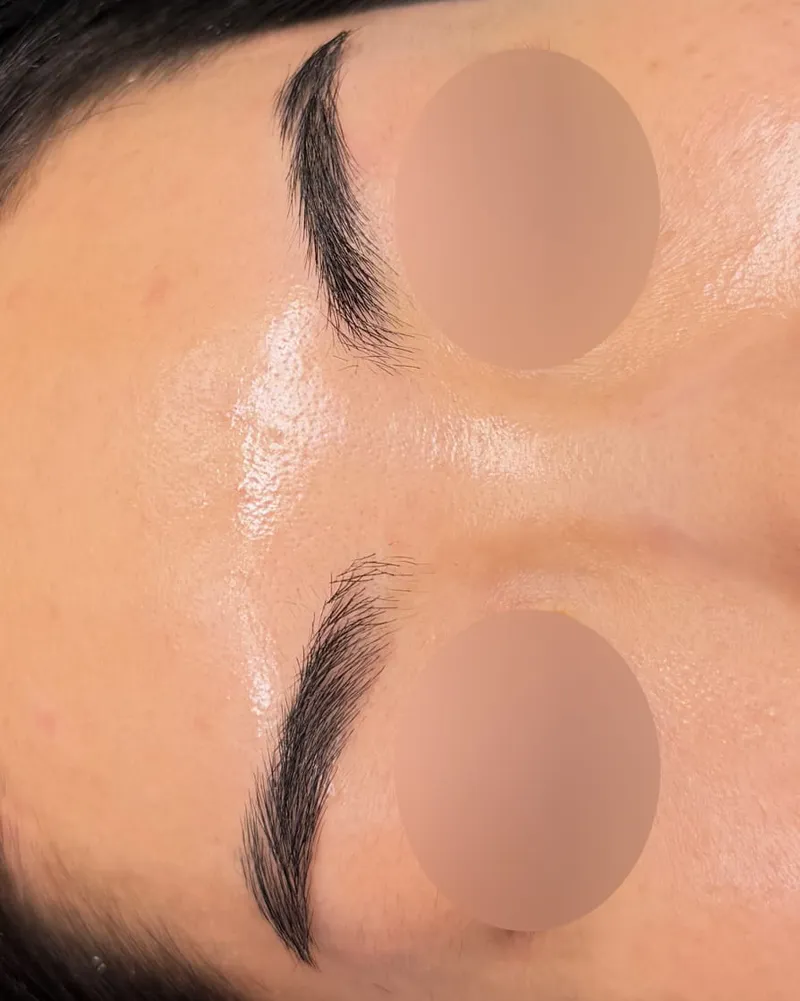 Permanent Makeup Removal after