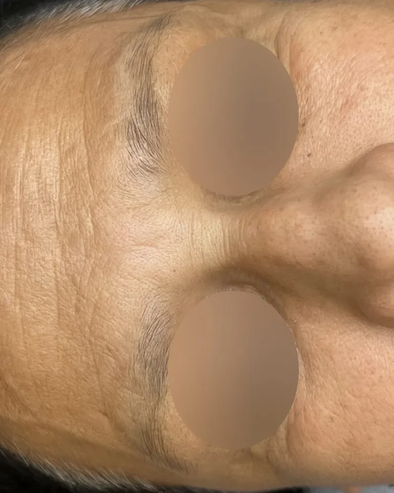 Permanent Makeup Removal after