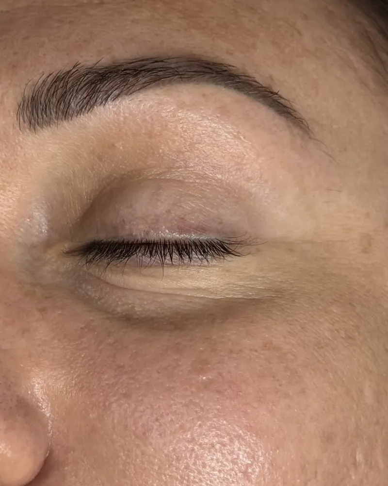 Permanent Makeup Removal after