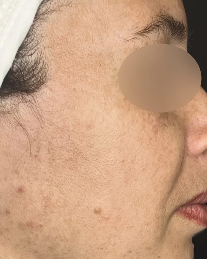 IPL Photofacial after