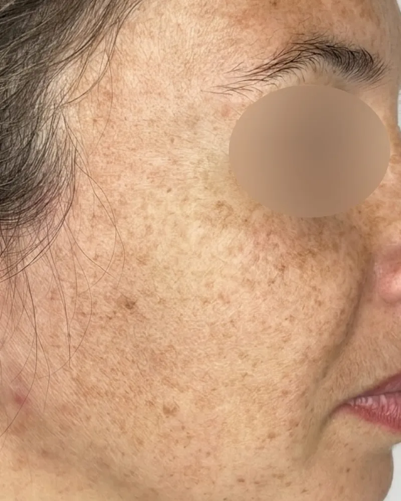 IPL Photofacial before