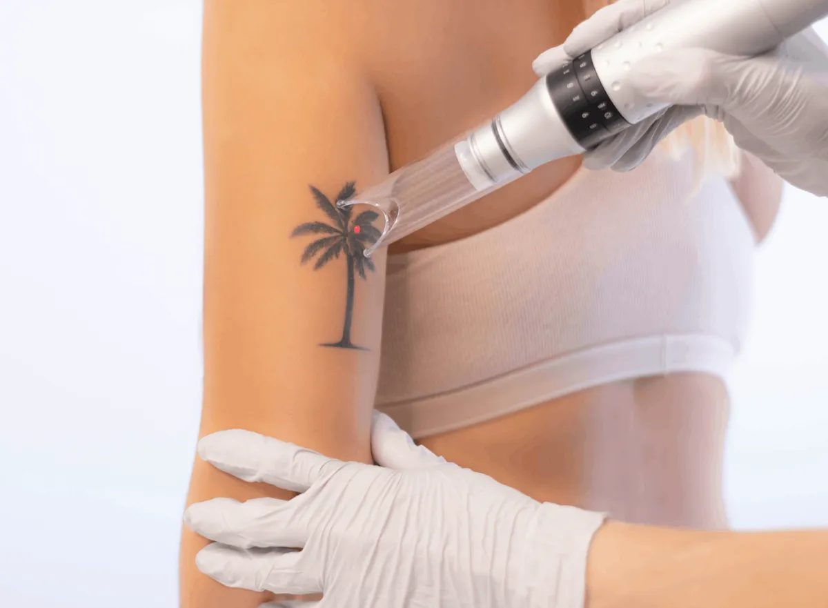 Laser Tattoo Removal